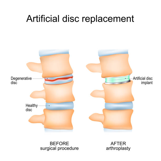 Disc replacement surgery in delhi