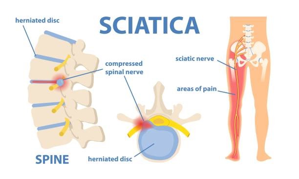 Best Doctor for Sciatica Treatment in Delhi